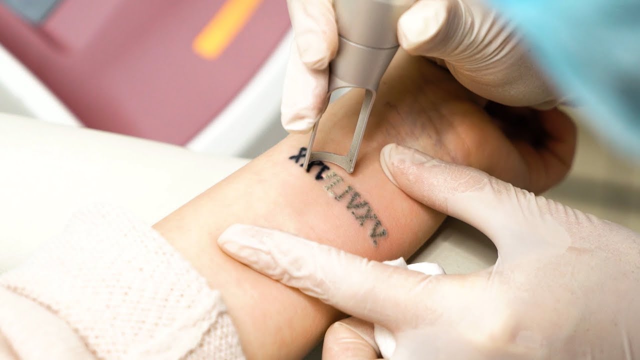 Îndepărtarea tatuajelor și machiajului permanent